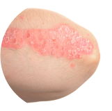 Psoriasis