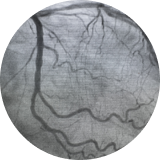 Enfermedad arterial coronaria