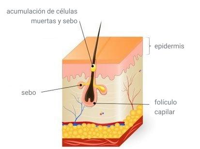 Fotos y etapas del acne