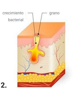 Fotos y etapas del acne