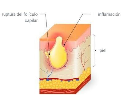 Fotos y etapas del acne