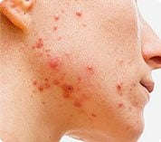 Etapa inflamatoria
