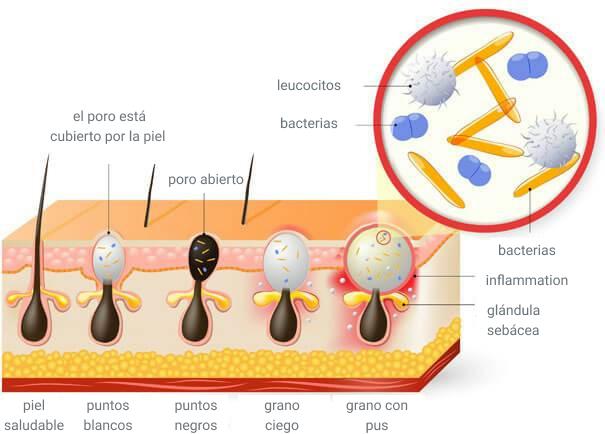 Tipos de acne