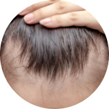 Caída del pelo en la frente