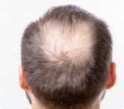 Alopecia androgenética o androgénica
