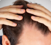 Alopecia de patrón masculino