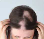 Alopecia areata