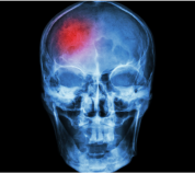 Traumatismo craneal y cerebrovascular