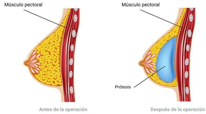 ΠΛΑΣΤΙΚΗ ΣΤΗΘΟΥΣ γραφημα