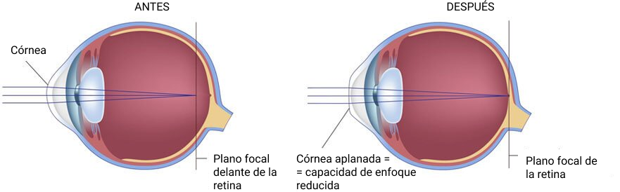 combate Rítmico bebida Cirugía LASIK: ¡Trata la miopía y el astigmatismo de forma definitiva!