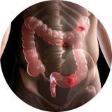 La Enfermedad Inflamatoria Intestinal