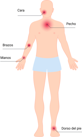 Dermatitis Adult