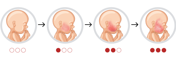 Dermatitis en bebés