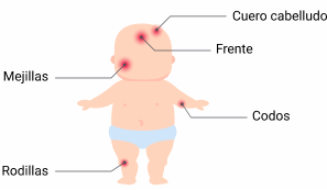Dermatitis en bebés