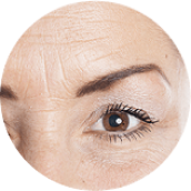 Arrugas faciales