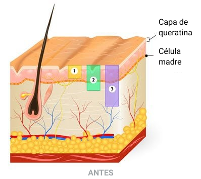 Peeling Quimico