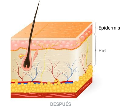 Peeling Quimico
