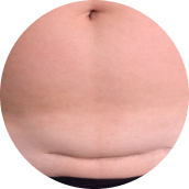 Lesiones abdominales o después de la cirugía