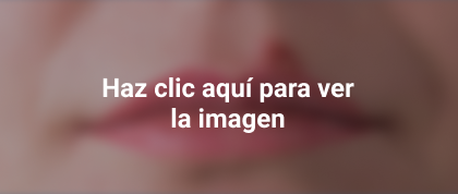 herpes labial