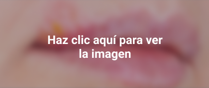 herpes labial