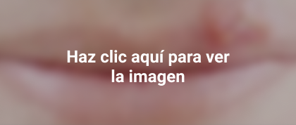 herpes labial