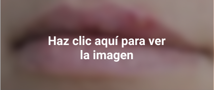 herpes labial