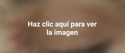 herpes en el oído, ojo y la nariz