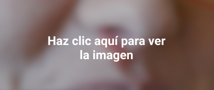 herpes en el oído, ojo y la nariz