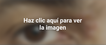 herpes en el oído, ojo y la nariz