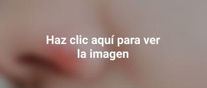 herpes en el oído, ojo y la nariz