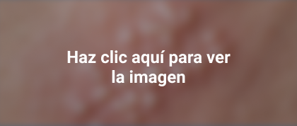 herpes zoster