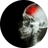 Accidente cerebrovascular (ACV)