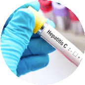 Hepatitis