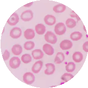 Anemia falciforme