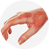 Cicatrices de quemaduras