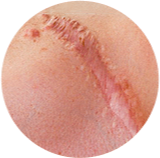 Cicatrices postraumáticas