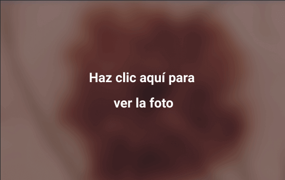 Melanoma 11