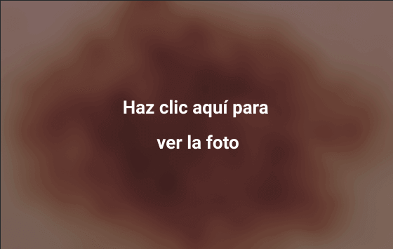 Melanoma 7