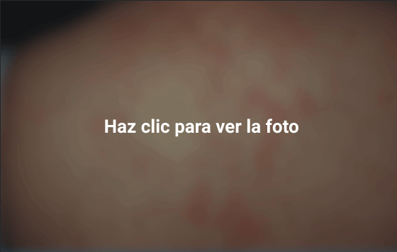 Sarampion en adultos